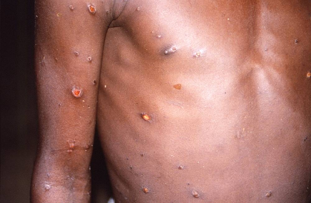 An image created during an investigation into an outbreak of monkeypox, which took place in the Democratic Republic of the Congo, 1996 to 1997, shows the arms and torso of a patient with skin lesions due to monkeypox, in this undated image obtained by Reuters on May 18, 2022. — CDC/Brian W.J. Mahyd handout via Reuters
