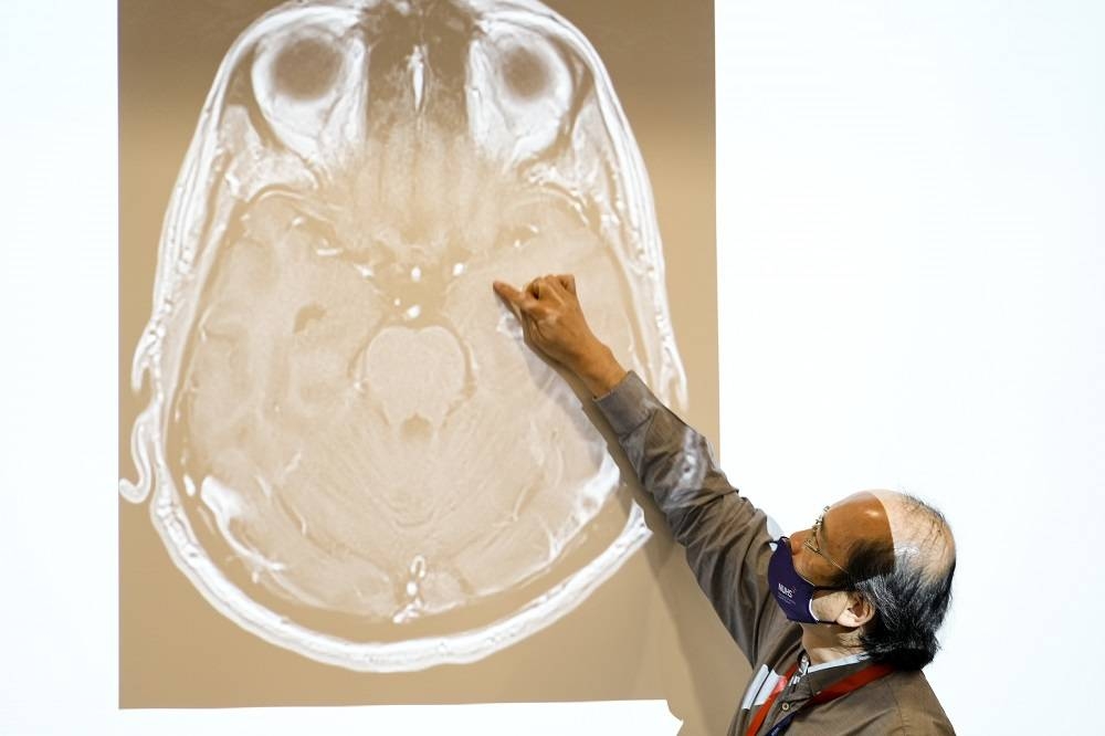 Clinical Associate Professor Yeo Tseng Tsai using a magnetic resonance imaging scan to show the location of Maideen Sadayan’s brain tumour, which is roughly the size of an almond. — Picture by Singapore National University Health System via TODAY