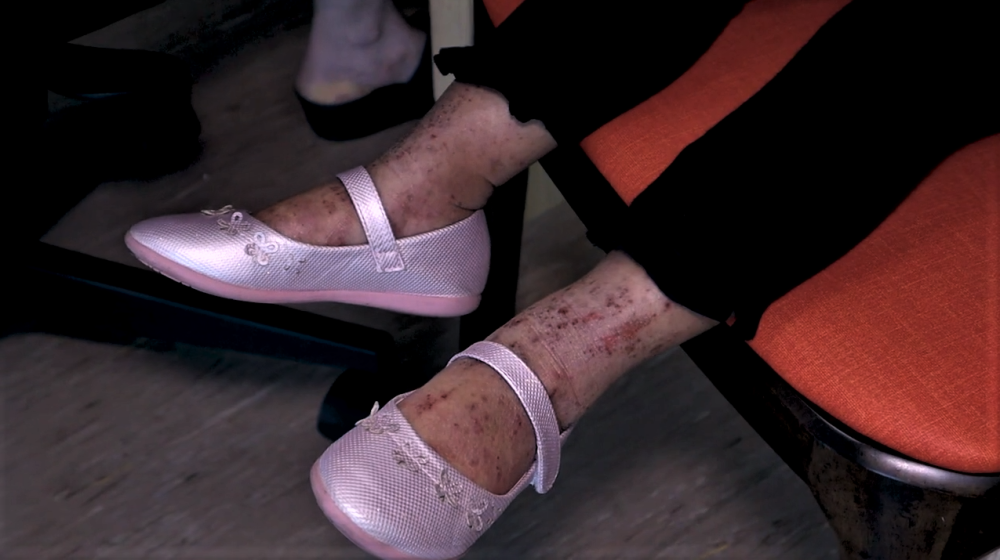 Atopic dermatitis is a common skin condition among children. 