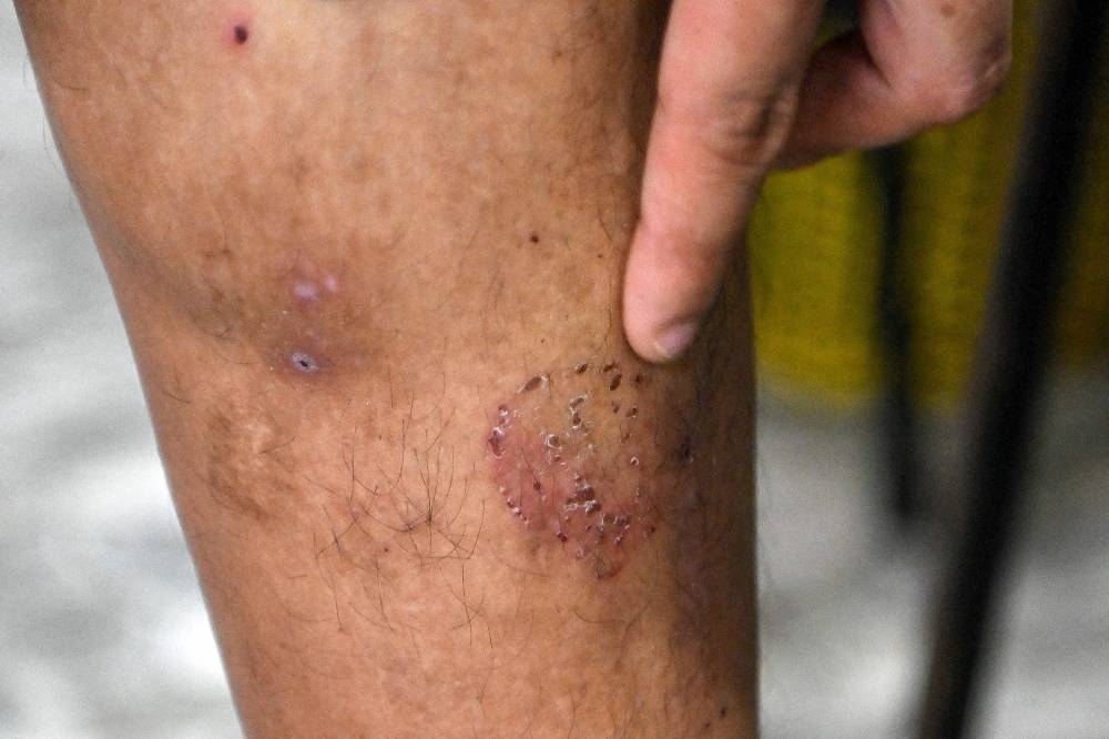 In this photo taken on September 27, 2022 in Phnom Penh, a victim of a Chinese scamming gang shows a scar on his leg after he was tortured.— AFP  pic