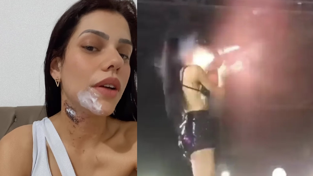 Brazillian DJ accidentally fires confetti cannon at her own face, suffers first degree burns - Vimarsana News