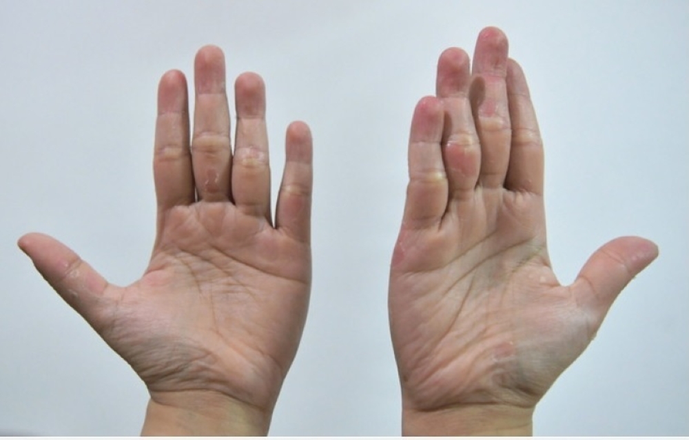 State Health and Unity Committee chairman, Ling Tian Soon, said that the cumulative number of HFMD cases in the Johor Baru district recorded the highest number, at 607. — Bernama file pic