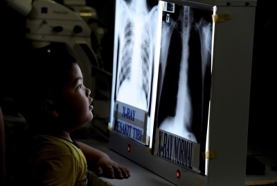 UK to introduce X-ray age checks for asylum seekers - Vimarsana News
