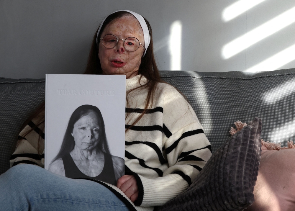 Belgian Patricia Lefranc, victim and survivor of an acid attack in 2009, poses for Reuters with a fashion look book ‘Tear Couture’  by British photographer Rankin and charity Acid Survivors Trust International, launching a new campaign aiming to highlight the link between the textiles industry and incidences of acid attacks, in Nivelles, Belgium January 16, 2024. — Picture by Rankin/ courtesy of McCann Health London via Reuters