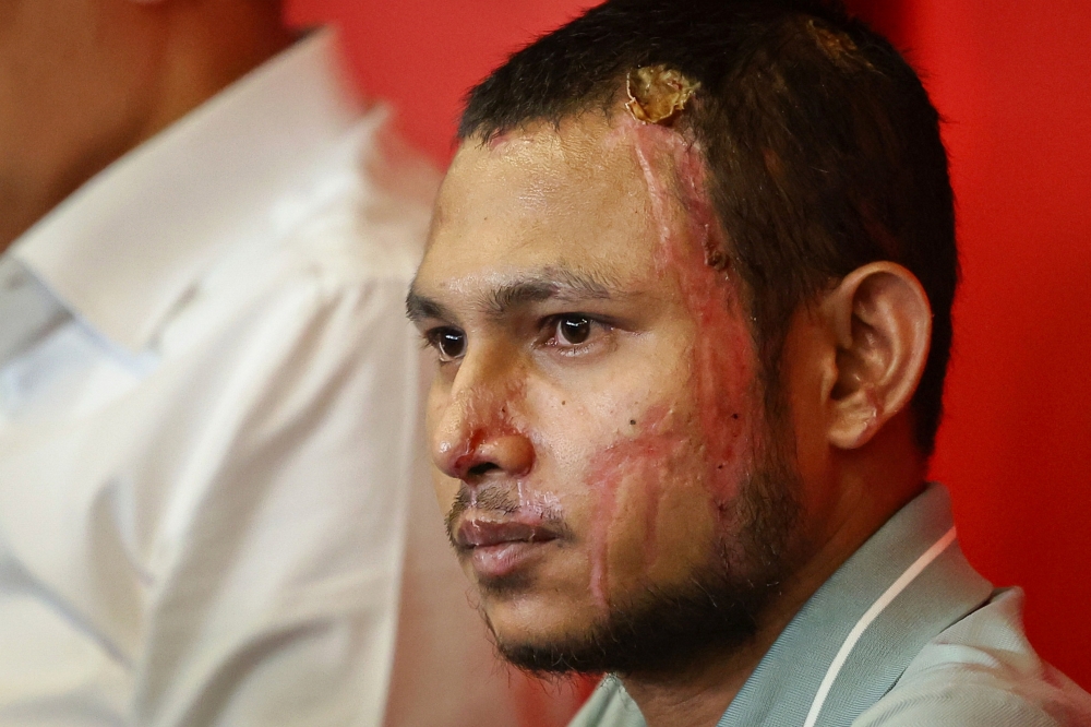Faisal Halim, affectionately known as ‘Mickey’ to fans, suffered fourth degree burns in an acid attack by an unknown assailant at a shopping centre in Petaling Jaya on May 5. — Bernama pic 