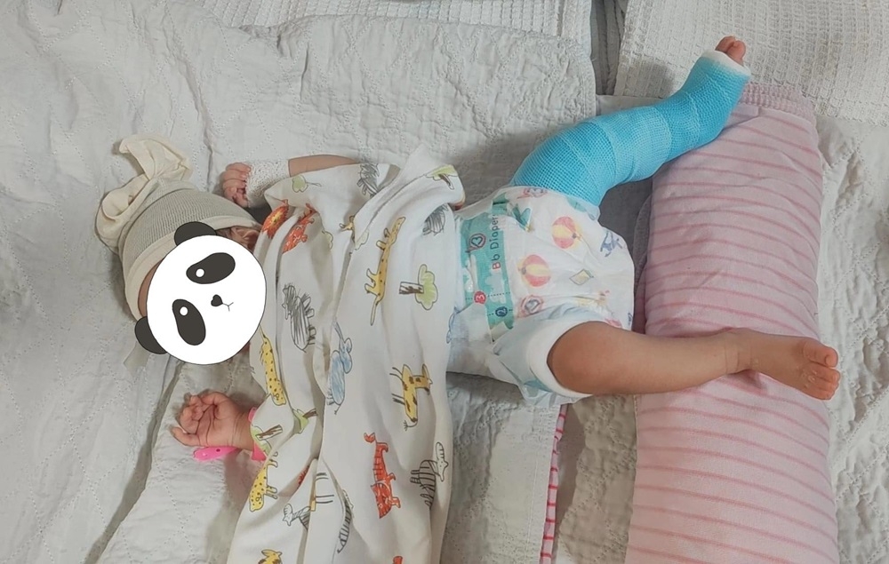 The two-month-old baby girl is seen with her left leg in cast after suffering a thigh bone fracture. Police have since arrested the babysitter for child abuse. — Picture via Facebook/Fione May