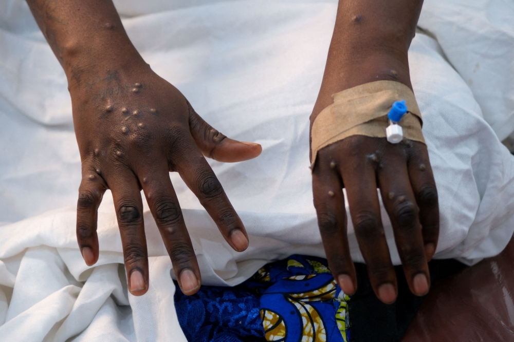 The hands of a patient with skin rashes caused by the mpox virus are pictured at the treatment centre of Vijana Hospital in Kinshasa, Democratic Republic of Congo August 30, 2024. — Reuters pic