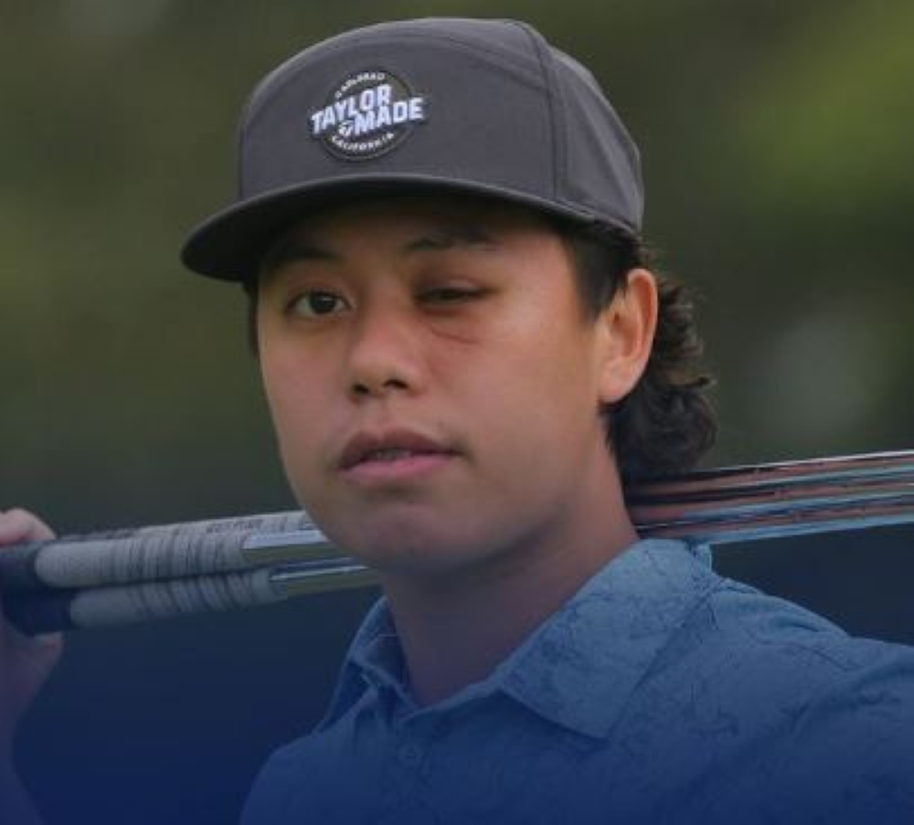 Jeffrey Guan, 20, was hit in the face by a ball at a tournament south of Sydney in late September, suffering a serious fracture to his left cheekbone and eye socket. — Picture via Instagram/jeffreyguan04