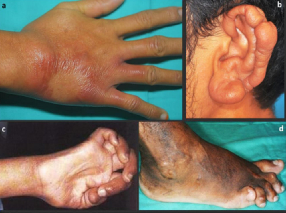 Some of the symptoms of leprosy. — Picture from UPM website