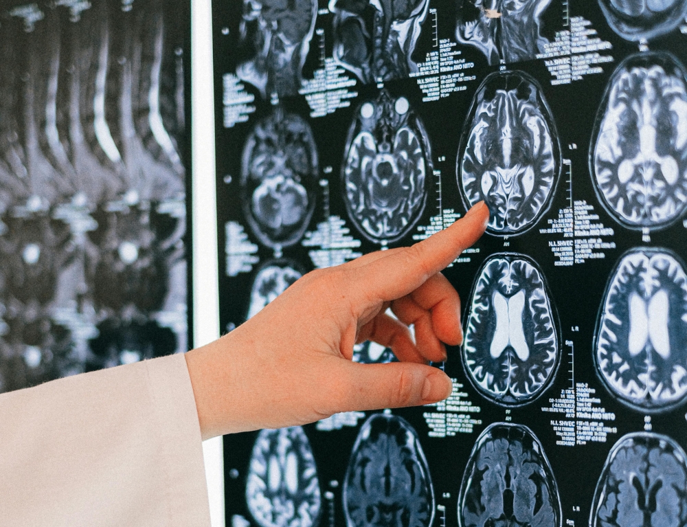 There are three main types of stroke: ischemic stroke, which accounts for approximately 78 per cent of cases; haemorrhagic stroke (18 per cent); and transient ischemic attack, which occurs in about two per cent of cases. — Pexels.com pic 