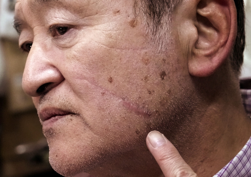 Keiji Minatoya, 68, a confectionery shop owner who was attacked by a black bear in front of the garage in his backyard on October 19, 2023, points to a scar on his face from the attack, during an interview with Reuters in Kitaakita, Akita Prefecture, Japan, November 6, 2025. — Reuters pic