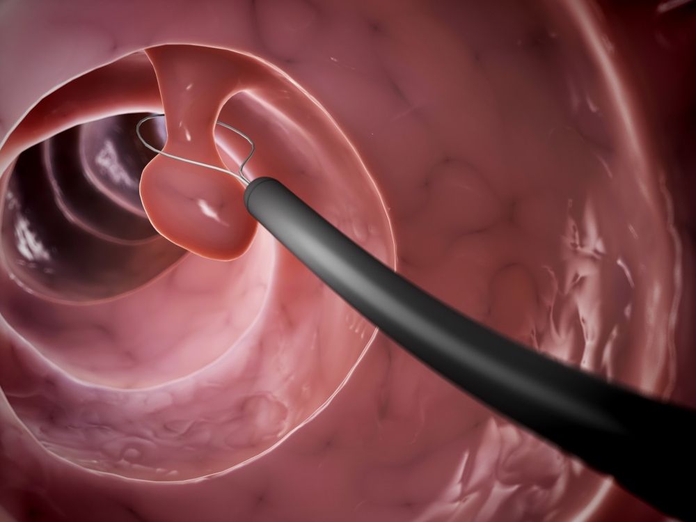 Colonoscopy, the gold standard, allows doctors to both diagnose and remove any suspicious growths during the same session.