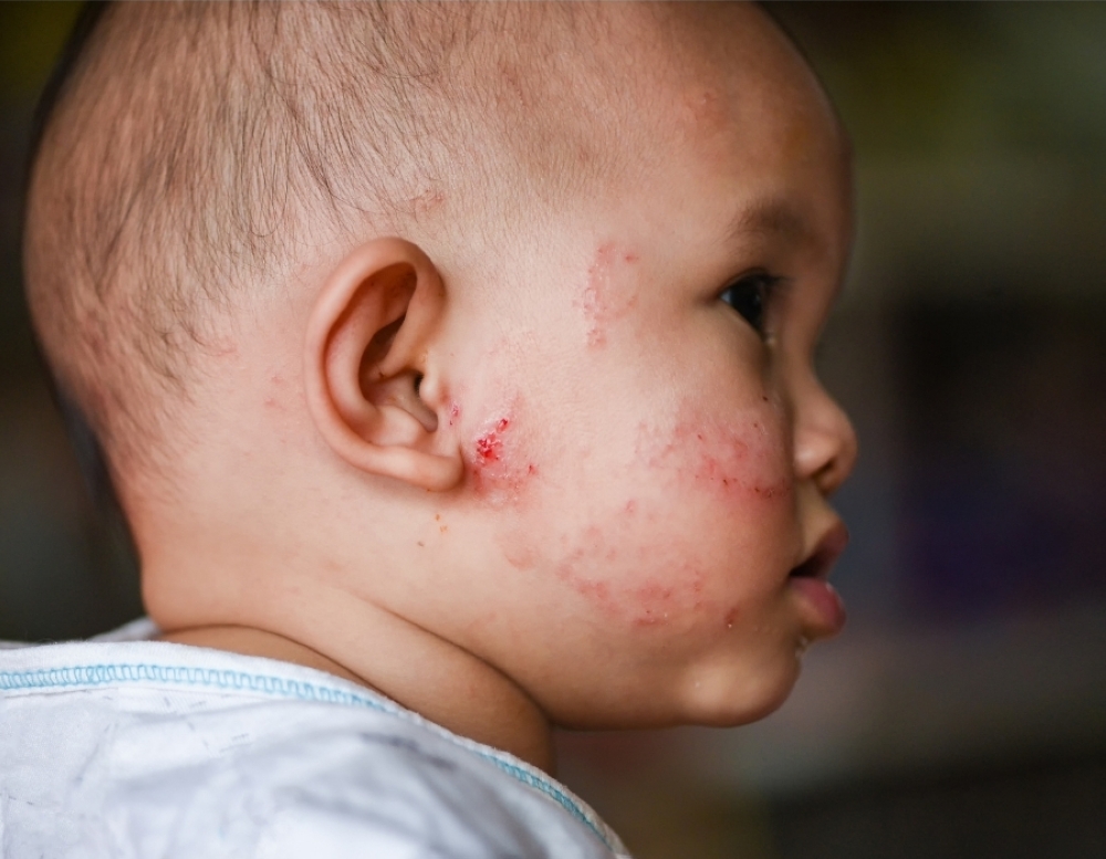 Rising misuse of unregulated creams and delays in treatment are driving more severe eczema cases. — Picture courtesy of Oriental Melaka Straits Medical Centre