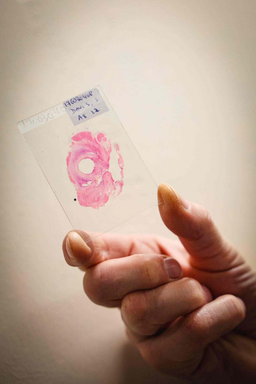 This photo taken on January 14, 2026 shows a cross section of a cancer sample removed in surgery, sandwiched between two slides, pictured in a storeroom at St Mark's hospital at Northwick Park in Harrow, west London. — AFP pic