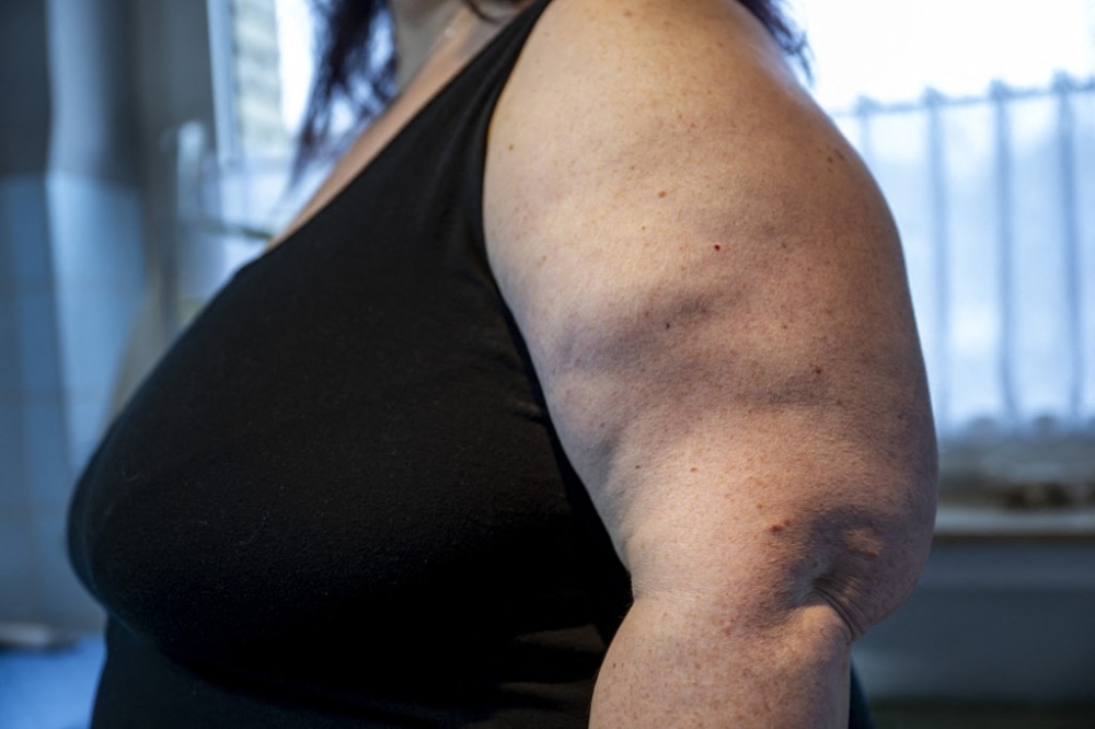 A woman stands in her bathroom and shows off her upper arms February 14, 2024, Lower Saxony, Bissendorf. Lipoedema is a progressive fat distribution disorder that often leads to a massive increase in volume, especially on the arms and legs, and is usually accompanied by severe pain, a tendency to haematoma and psychological stress. — David Inderlied/DPA/dpa Picture-Alliance pic via AFP