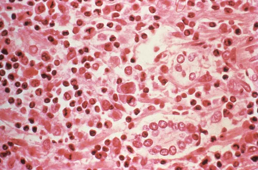 This 1994 handout photo from the US Centers for Disease Control and Prevention (CDC) obtained on May 6, 2026, shows a photograph taken through a microscope of a liver tissue specimen that was extracted from a hantavirus pulmonary syndrome (HPS) patient. — US Centres for Disease Control and Prevention (CDC) handout/AFP pic 