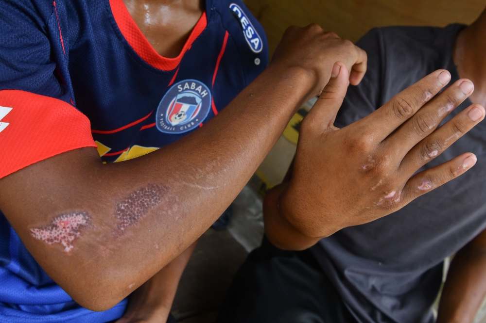 Teen motorcyclist Mohamad Syafid Ikhmal Muhamad Zailani, 17, shows his injuries after a crash involving three cows during heavy rain near Kampung Limau Kasturi in Gua Musang, Kelantan. — Bernama pic