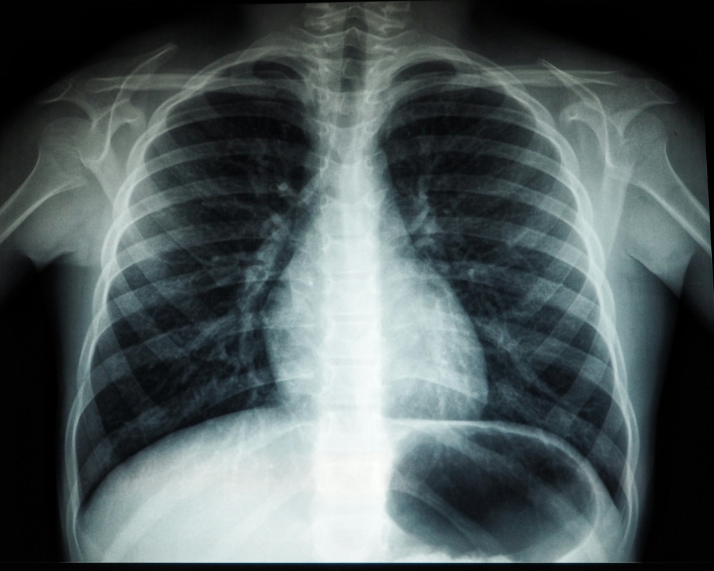Penang clinic joins first phase of national lung health initiative using AI screening