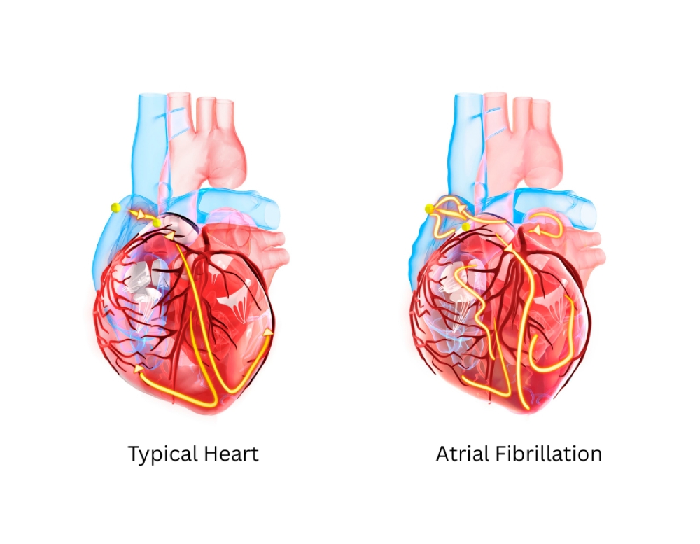 The most serious complication of atrial fibrillation is stroke. During atrial fibrillation, blood clots may form in the heart and travel through the bloodstream to the brain, where they can block an artery and cause a stroke.