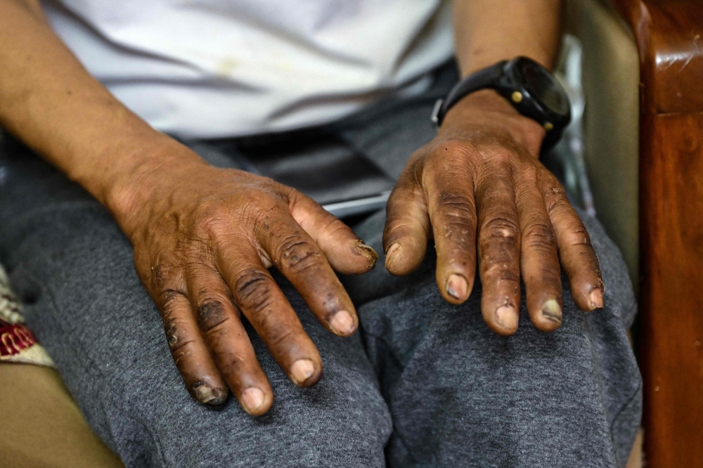 Everest survivor Dawa Sherpa shows his frostbitten hands during an interview with AFP in Kathmandu June 18, 2026. — AFP pic