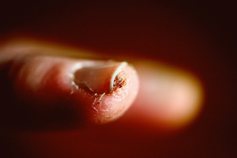 Eczema isn’t ‘just dry skin’ — and social media cures could make it worse