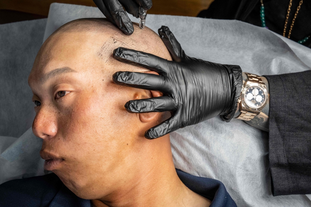 This picture taken on May 19, 2026 shows scalp tattoo artist Remy performing scalp micropigmentation procedure on client Koki Hatanaka at his studio in Ginowan, Okinawa prefecture. Japan bucks a global trend by viewing permanent make-up as the domain of medical professionals, and has ramped up threats of criminal prosecution against anyone else who practises it. Industry insiders insist that their craft, from make-believe hair to filled-in eyebrows and lip tints, is an artistic pursuit more befitting tattooists and hairstylists. But in a country where body art has long symbolised yakuza gangsters, these cosmetic tattooists' safety and sanitary protocols are not enough to dispel scepticism. — AFP pic