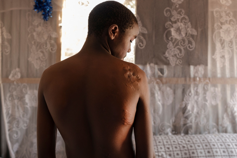The teenaged son of Mary Milka Tiren, 40, (not pictured) shows scars on his body from a crocodile attack on Lake Bogoria, a decade after he lost his father to another attack by a Hippopotamus in the wake of increased proximity of wildlife to human settlements around the rising lake in Marigat sub-county, Baringo county on July 28, 2026. Lake Baringo and other lakes in Kenya's Rift Valley have risen to levels not seen in at least half a century, with scientists attributing the surge to extreme rainfall linked to climate change. Tens of thousands of people have been displaced to higher ground, according to official disaster management data, yet many victims say the lakes keep following them. — AFP pic