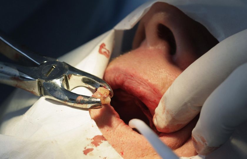 A dentist extracts a tooth from a patient at a dental clinic in Sabanilla near San Jose in this November 1, 2012 file photo. — Reuters pic