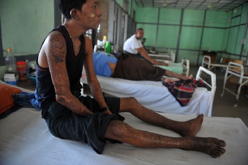 A patient sits on a bed at the Mawlamyine Christian leprosy hospital in Mawlamyine taken on March 13, 2013. u00e2u20acu201d AFP pic