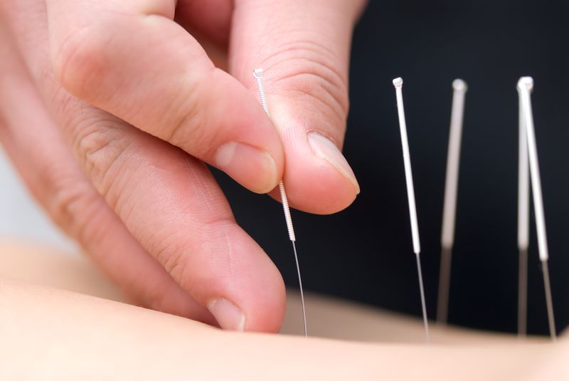 Acupuncture can provide effective pain relief in some parts of the body, including the neck. u00e2u20acu201d AFP pic
