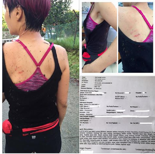 A screen capture of the post by blogger Rebecca Saw, showing the injuries she sustained after the snatch theft incident. u00e2u20acu201d Picture courtesy of Rebecca Saw/Facebook