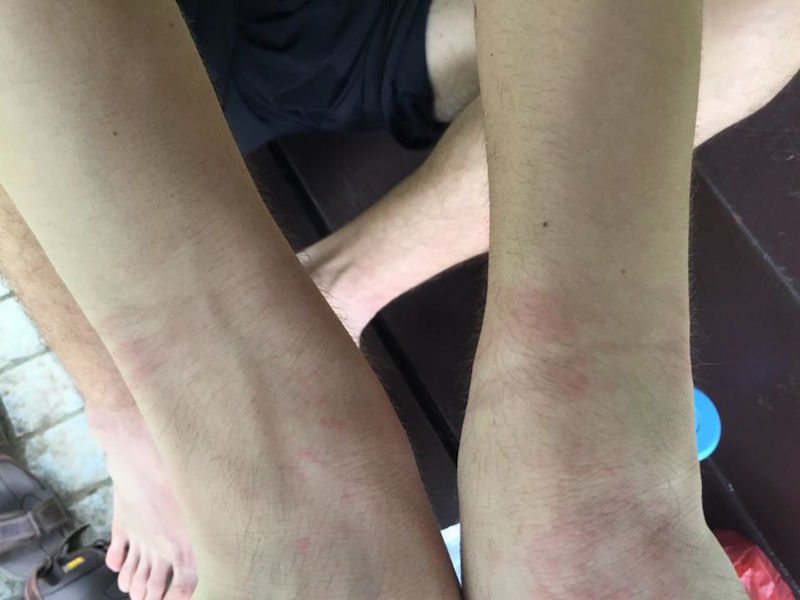 Sebastienu00e2u20acu2122s wrists show lingering redness after he was handcuffed by the police. His mother said the decision to grab her son was u00e2u20acu02dccompletely out of lineu00e2u20acu2122. u00e2u20acu201d Picture from Choo Kah Yingu00e2u20acu2122s Facebook page