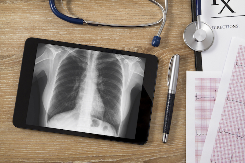 Doctors are testing a new approach to lung transplants. u00e2u20acu201d IStock.com pic via AFP