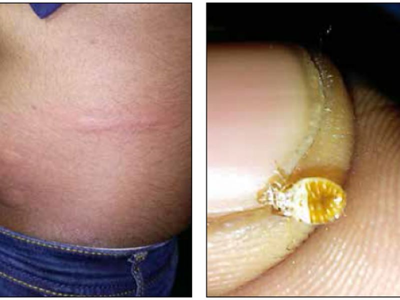 Yuvaraj Sivanathan showing the bites he suffered (left) and said he found at least two bedbugs (right) on his seat about half an hour into the journey from Kuala Lumpur to Singapore on Jan 11, 2017. u00e2u20acu2022 Picture courtesy of Yuvaraj Sivanathan/TODAY