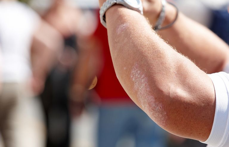 Keep on treating patches of eczema by applying cortisone creams in the evening after showering. u00e2u20acu201du00e2u20acu201d Picture by tirc83/Istock.com via AFP