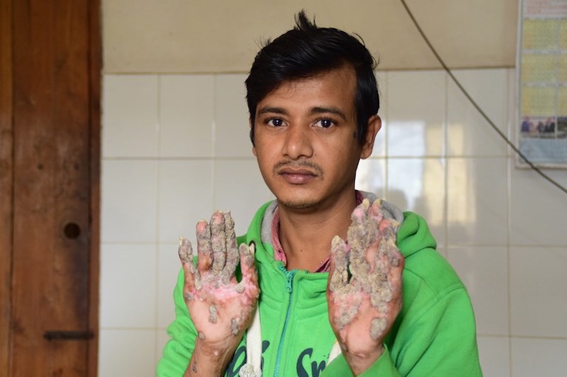 'Tree Man' Abul Bajandar showing his palms where the warts are regrowing at Dhaka Medical College Hospital January 25, 2018. u00e2u20acu201d AFP pic