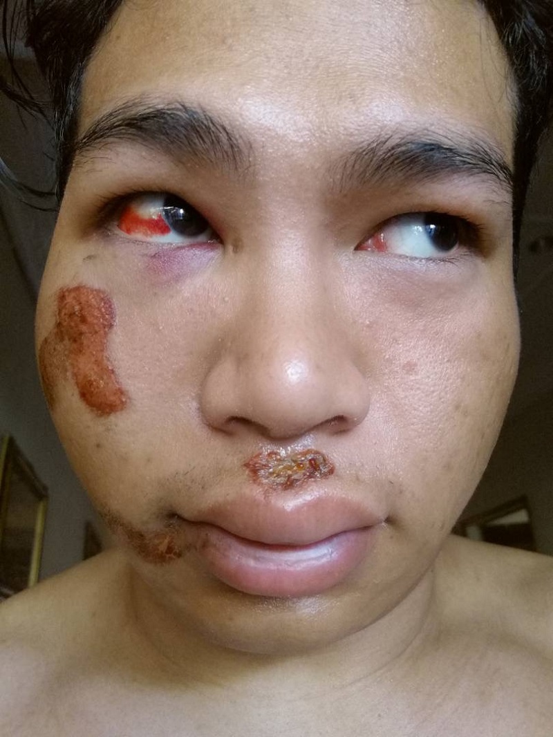 Personal trainer Nur Hidayat Hussin, 24, sustained injuries on his face after running into a pothole at Jalan Cheras. Picture was taken in May 2017. u00e2u20acu201d Malay Mail pix