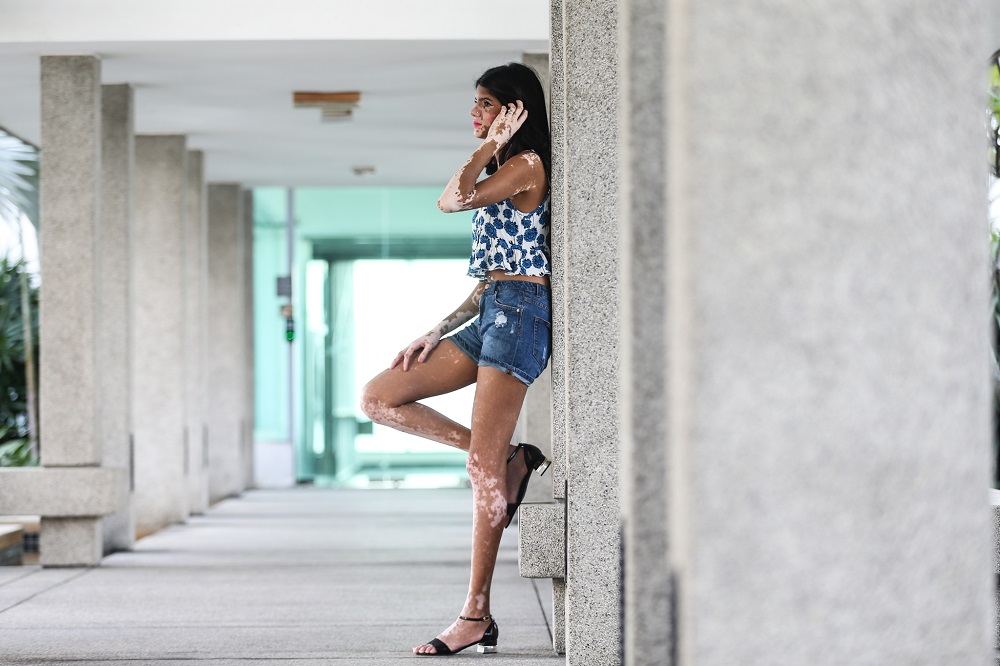 The Indian girl was inspired by the likes of Winnie Harlow, who also has vitiligo, as the mainstream modelling world now embrace more differences. 