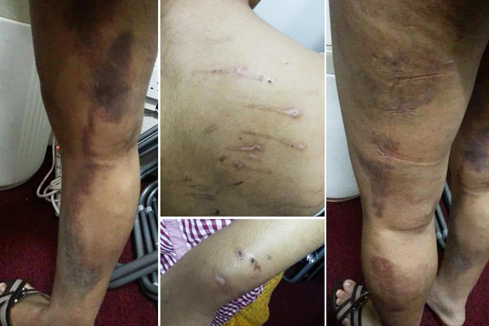 Injuries sustained by domestic helper Ei Phyu Tun after being assaulted by her employer on multiple occasions. u00e2u20acu201d Picture via TODAY