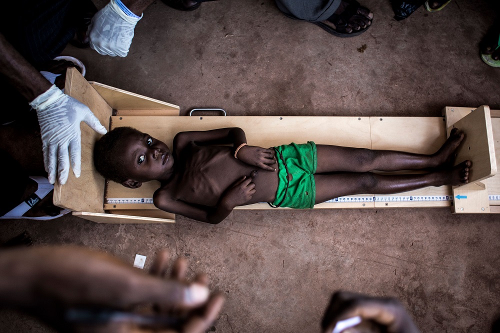 In this file photo taken on October 26, 2017, a malnourished child gets measured in a clinic treating cases of sever malnourishment in Tshikapa in the restive region of Kasai, central Democratic Republic of Congo. u00e2u20acu201d AFP pic  