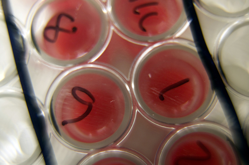 Roughly one in four people carry the TB bacteria in their bodies, and the WHO says more than 450 million people worldwide are type II diabetic. u00e2u20acu201d AFP pic