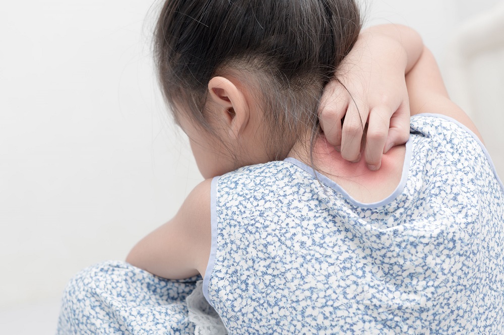 Is your little one suffering from eczema u00e2u20acu2022 Photo by 123RF