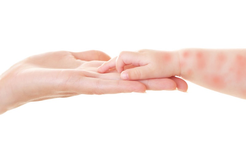 Between the ages of two to five, eczema tends to appear on ankles, wrists and hands.