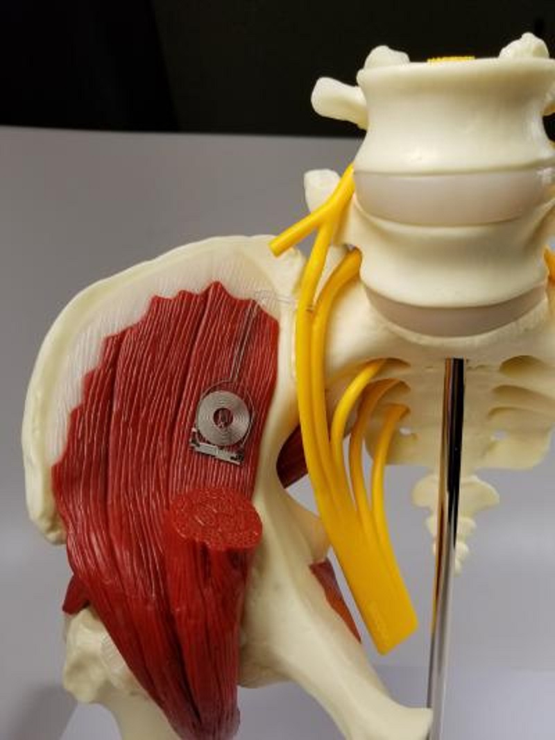 After around two weeks, this biodegradable device naturally absorbs into the body. u00e2u20acu201d AFP pic