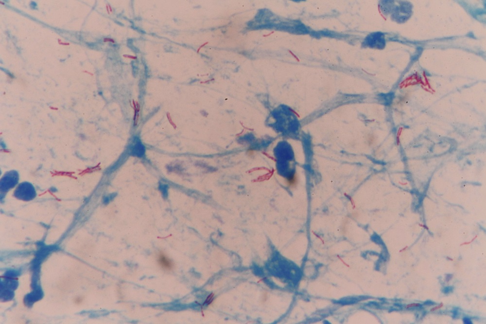 An estimated 240,000 children die from tuberculosis every year. The disease is curable and rarely deadly in infants if diagnosed and treated in time. u00e2u20acu201d AFP pic