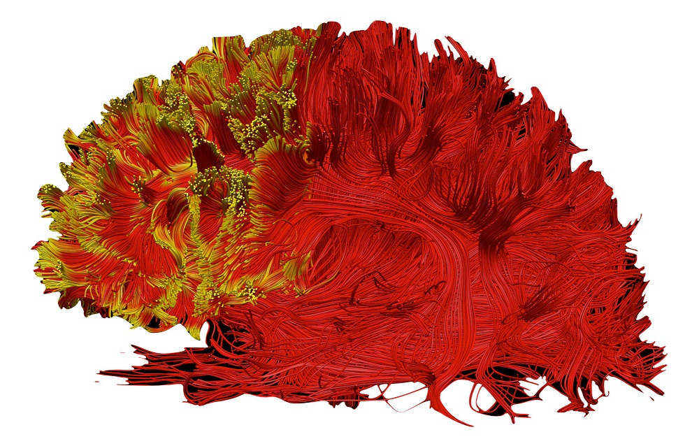 An illustration provides a 3D graphical representation of the altered connections, visualised with diffusion tractography (yellow tint), that are important for executive functions in people with ADHD. u00e2u20acu201d Reuters pic