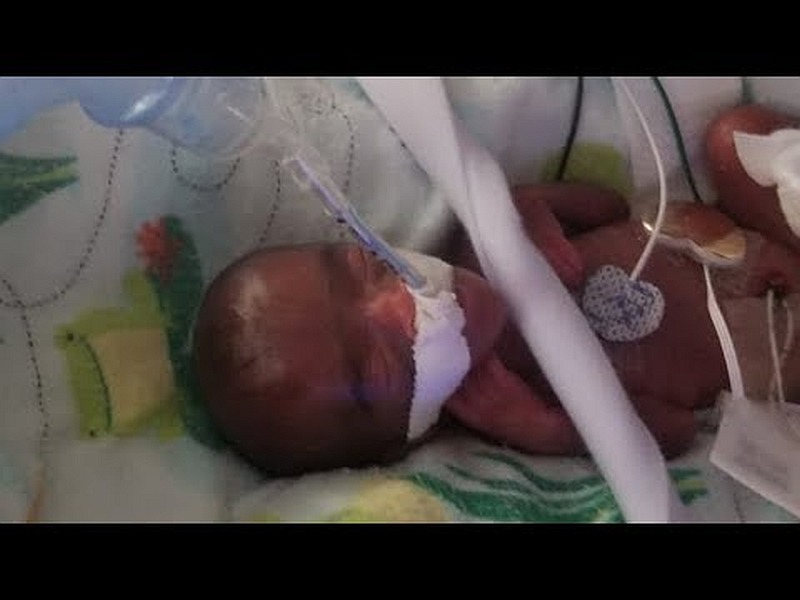 Image from the YouTube video: 'Worldu00e2u20acu2122s Smallest Baby Born in San Diego at Sharp Mary Birch Hospital.'