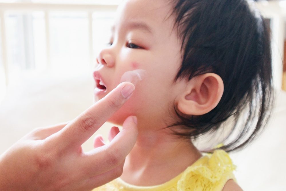 Taking care of a child with eczema can be tough, but providing your kid with care and support are some ways to manage the disease. u00e2u20acu2022 Picture via 123RF