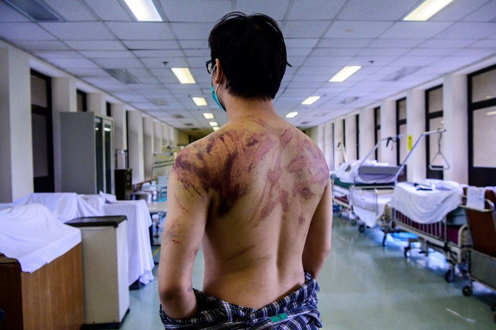 Calvin So, a resident of the rural town of Yuen Long near the border with mainland China, shows his wounds in a hospital corridor in Hong Kong, July 24, 2019, after he was assaulted on his way back home from a nearby restaurant where he works. u00e2u20acu201d AFP pic