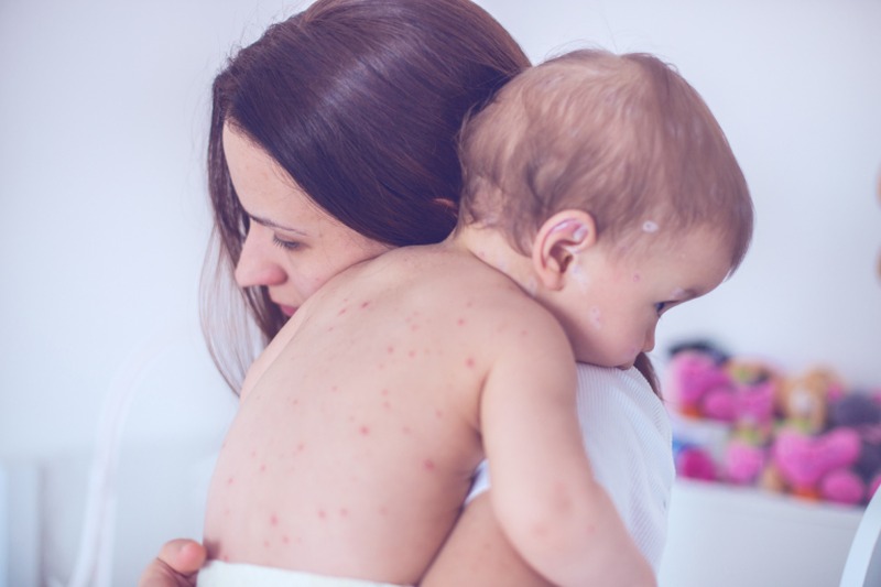 Measles, which is highly contagious, can be entirely prevented through a two-dose vaccine. u00e2u20acu2022 IStock.com/AFP pic